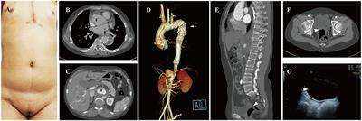 Unusual combination of acute aortic dissection, Mayer-Rokitansky-Küster-Hauser syndrome, and 46,XX gonadal dysgenesis: A case report